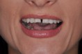 /album/chiusura-diastema-con-faccette-in-ceramica1/elenap1-jpg1/