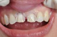 /album/chiusura-diastema-con-faccette-in-ceramica1/elenap2-jpg1/