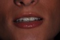 /album/chiusura-diastema-con-faccette-in-ceramica1/elenap3-jpg1/