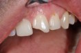 /album/ricostruzione-estetica-in-composito1/dsc-0091-jpg1/